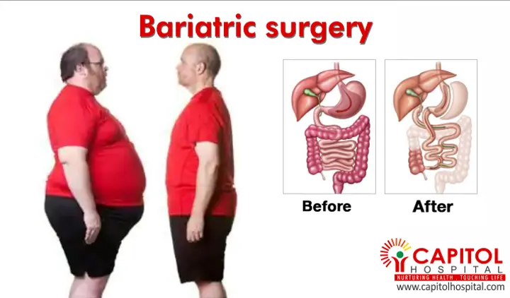 Top 5 Bariatric Surgery Facts Everyone Should Know