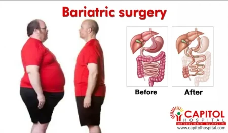 Top 5 Bariatric Surgery Facts Everyone Should Know